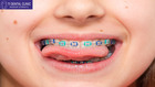 Tidental Dental Implants for Restoring Your Smile