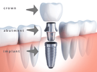 Best Dental Implant Treatment in Gurgaon